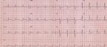 Cholesterol-čím méně, tím lépe. I kvůli covidu